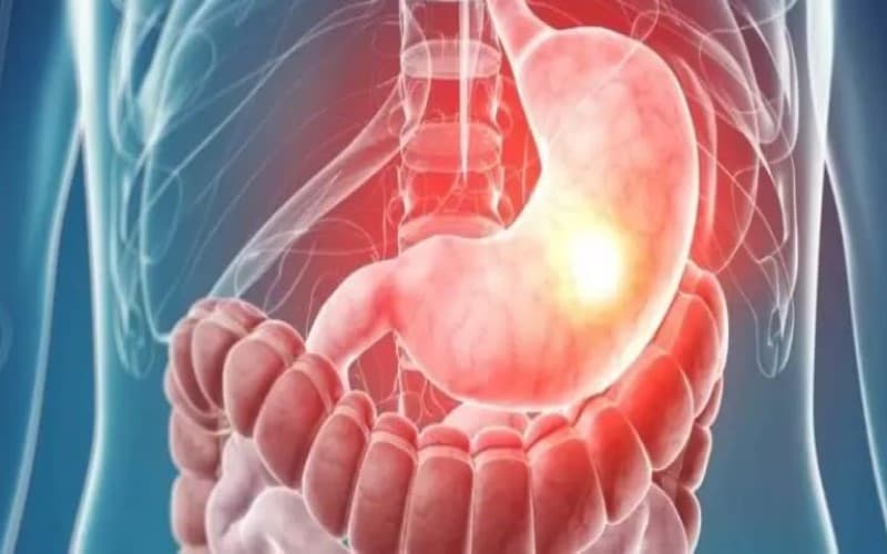 ung thư dạ dày giai đoạn 3