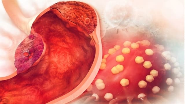 Dấu hiệu ung thư dạ dày giai đoạn 3 chưa di căn