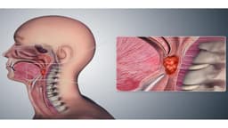 Bệnh ung thư vòm họng có lây không?