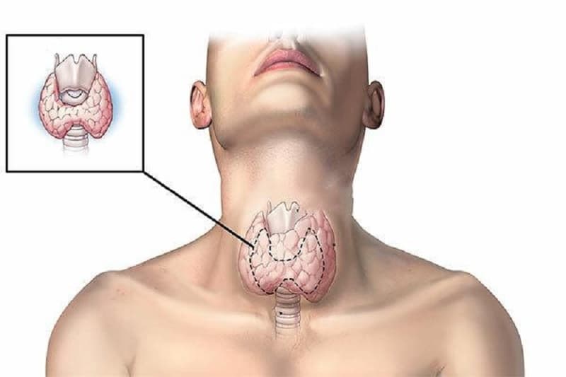 sau mổ tuyến giáp bao lâu thì uống phóng xạ