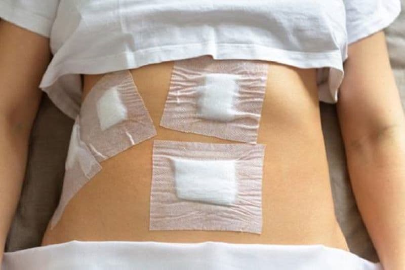 vết thương mổ nội soi bao lâu thì lành