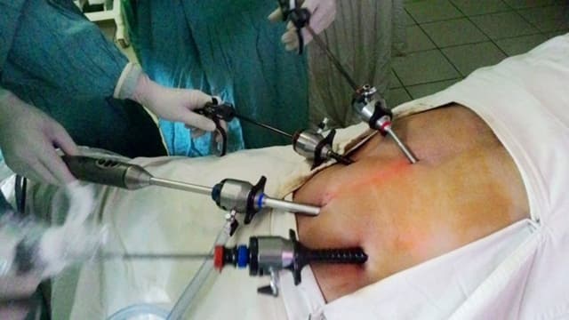 Vết thương mổ nội soi bao lâu thì lành?