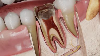 Phân biệt viêm tủy răng có hồi phục và không hồi phục