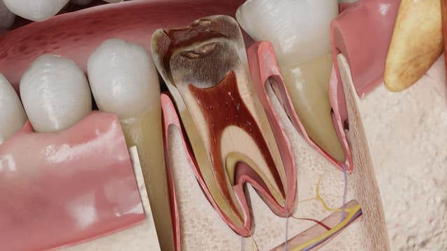 Phân biệt viêm tủy răng có hồi phục và không hồi phục