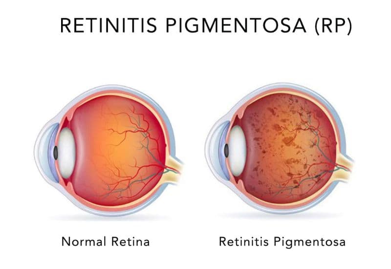 viêm võng mạc sắc tố