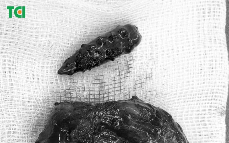 Hình ảnh viên đạn sau khi được gắp khỏi đùi người bệnh