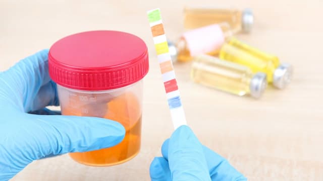 Xét nghiệm ACR nước tiểu có ý nghĩa gì?