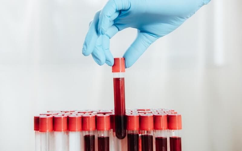 hct cao trong xét nghiệm máu là gì