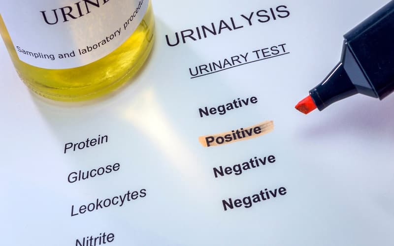 negative nghĩa là gì trong xét nghiệm nước tiểu