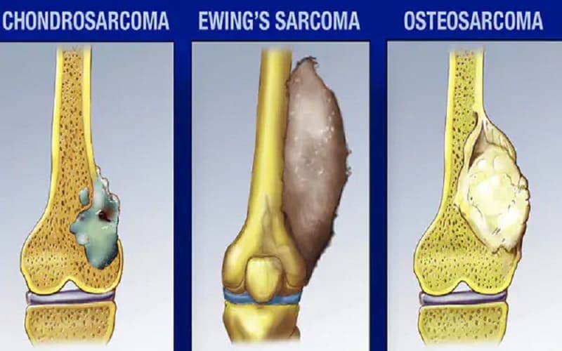 xét nghiệm máu có phát hiện ung thư xương không