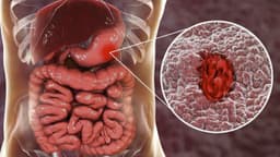 Xuất huyết dạ dày điều trị như thế nào?