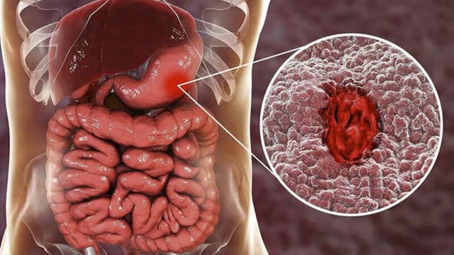 Xuất huyết dạ dày điều trị như thế nào?