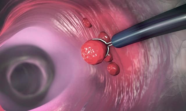 Cắt polyp dạ dày có phải kiêng gì không?