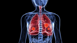 Ung thư phổi phát hiện sớm có chữa được không?