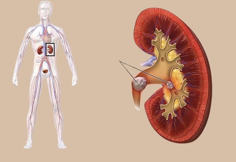 sỏi tiết niệu và sỏi thận