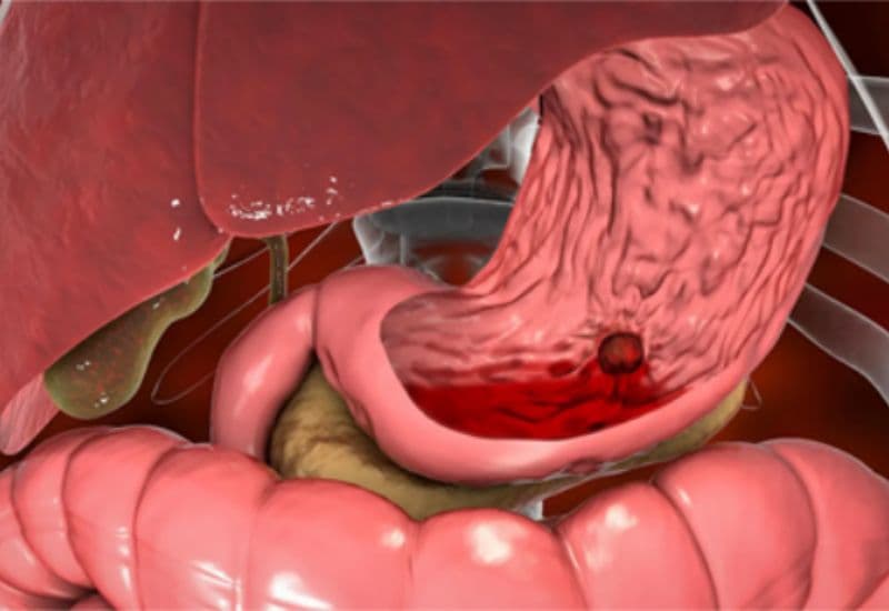 cắt polyp dạ dày có nguy hiểm không