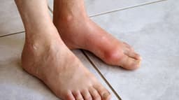 Các dấu hiệu bệnh gout giai đoạn đầu