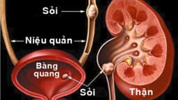 Có cách nào đẩy sỏi niệu quản ra ngoài hay không?