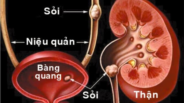 Có cách nào đẩy sỏi niệu quản ra ngoài hay không?