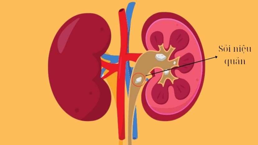 Người bị sỏi niệu quản có quan hệ được không? Sau tán sỏi niệu quản bao lâu thì quan hệ được?