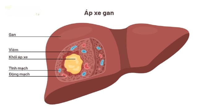 Áp xe gan có nguy hiểm không? Có chữa được không?