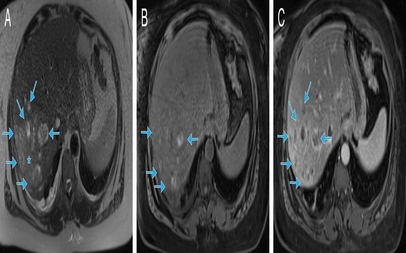 áp xe gan ở người bệnh đái tháo đường