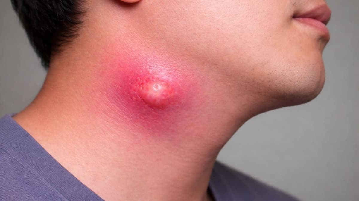 Áp xe ở cổ có nguy hiểm không?