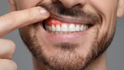 Áp xe răng để lâu có sao không? Có gây nhiễm khuẩn rộng?