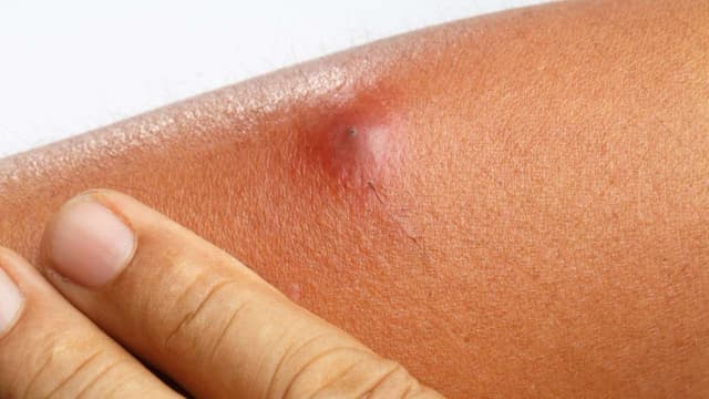 Tìm hiểu: Áp xe tái đi tái lại nguy hiểm thế nào?