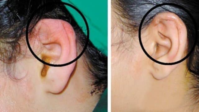 Áp xe tai khi xỏ khuyên: Chớ chủ quan