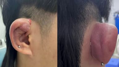 Áp xe tai là gì? Các vị trí áp dễ bị và vì sao cần điều trị sớm?