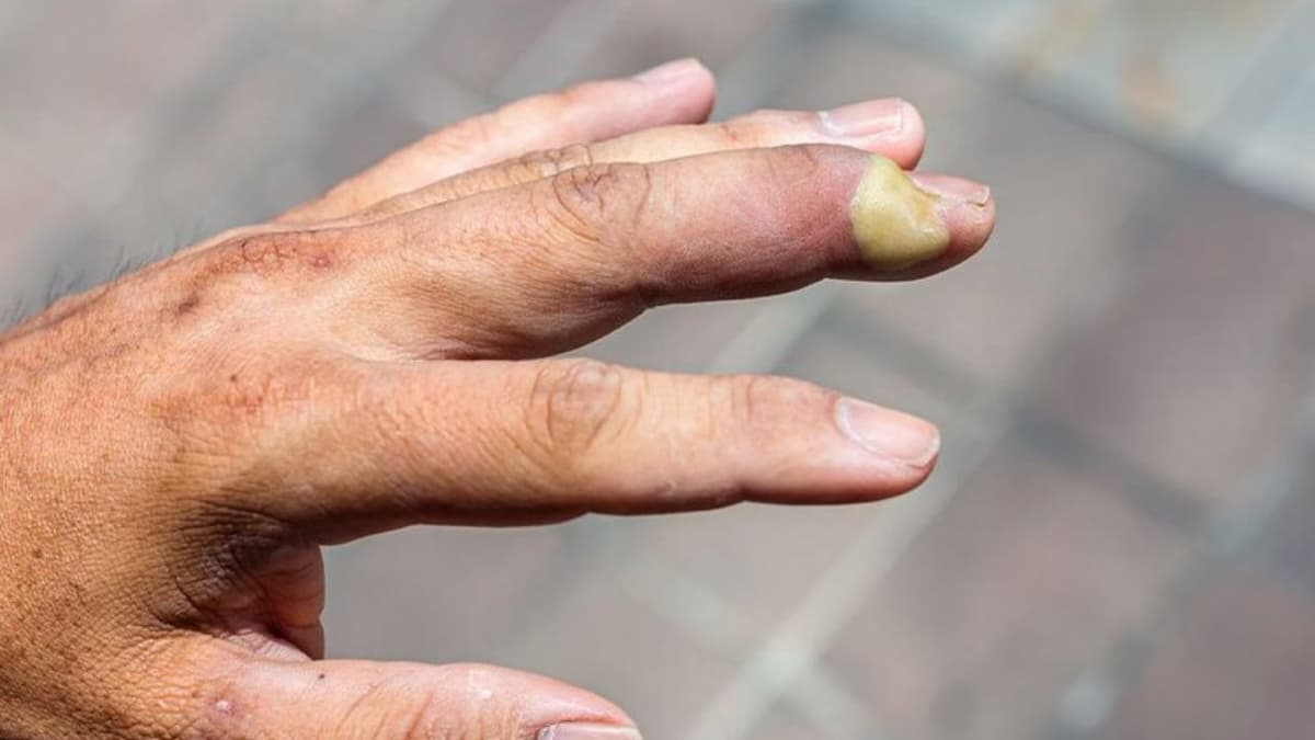 Các vị trí áp xe tay dễ gặp và khi nào là nguy hiểm cần đi khám