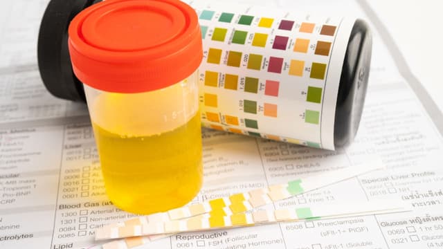 Chỉ số ASC trong xét nghiệm nước tiểu là gì?