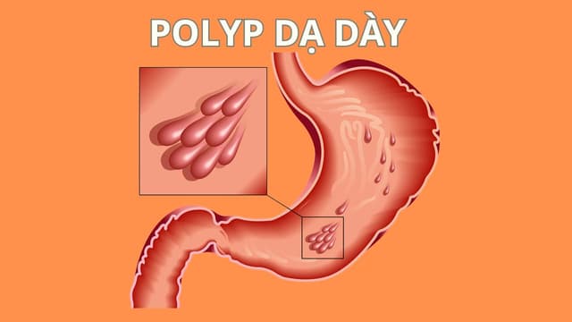 Cắt polyp dạ dày có mọc lại không?