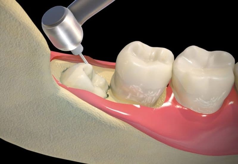 bao nhiêu tuổi hết mọc răng khôn