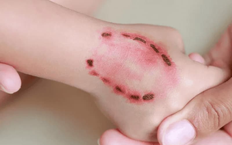 bệnh dại ủ bệnh 10 năm