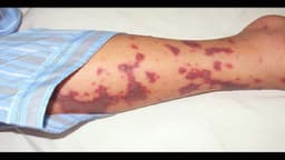 Bệnh nhiễm trùng máu có lây không? Có di truyền không?