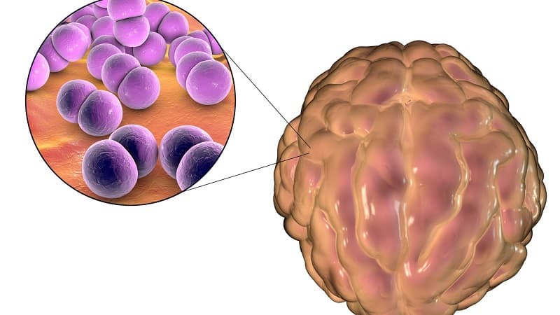 viêm màng não có lây không