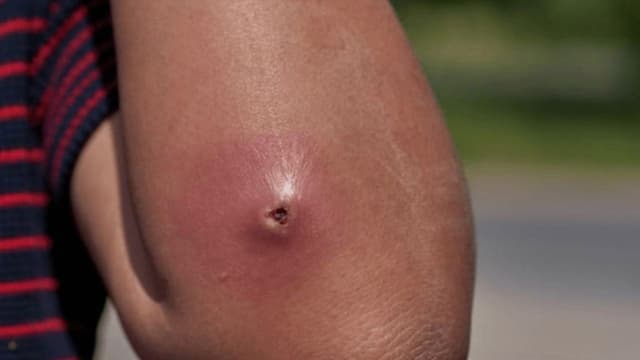 Bị áp xe có ăn được thịt bò không?