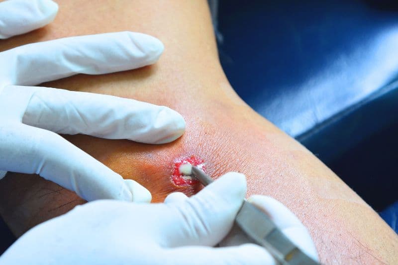 nặn mụn bị áp xe