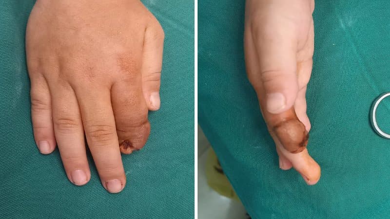 bị bỏng uống thuốc kháng sinh gì