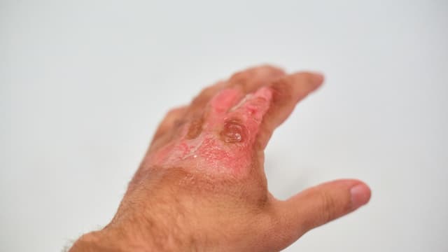 Bị bỏng uống thuốc kháng sinh gì?