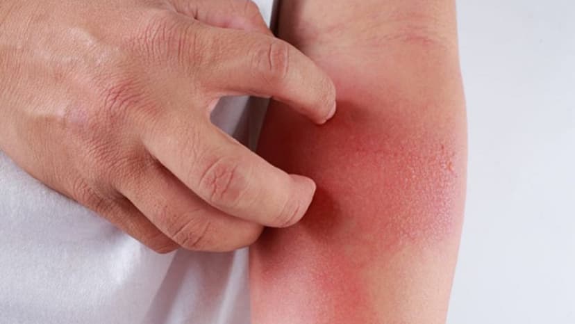 Bị dị ứng thuốc kháng sinh nên làm gì?