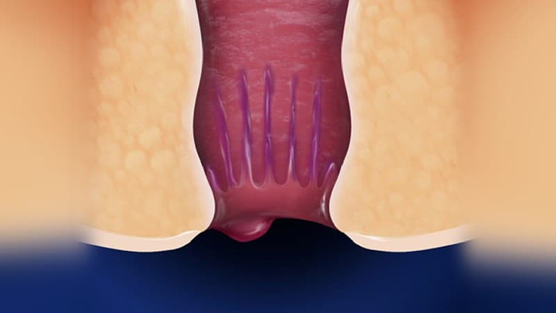 xuất huyết hậu môn là bệnh gì