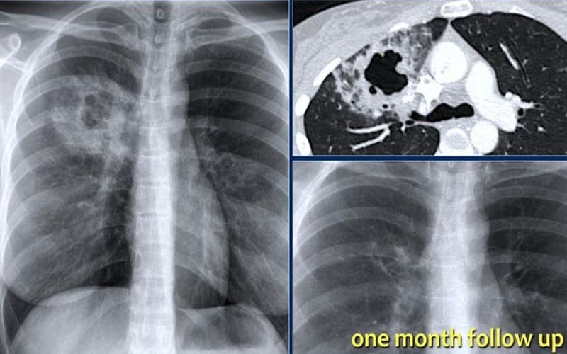 nhiễm trùng phổi là gì