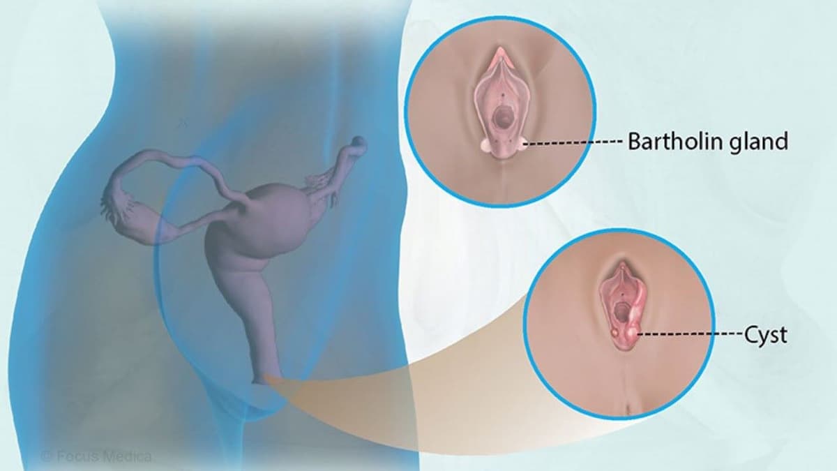 Bóc nang tuyến Bartholin bao lâu thì lành?