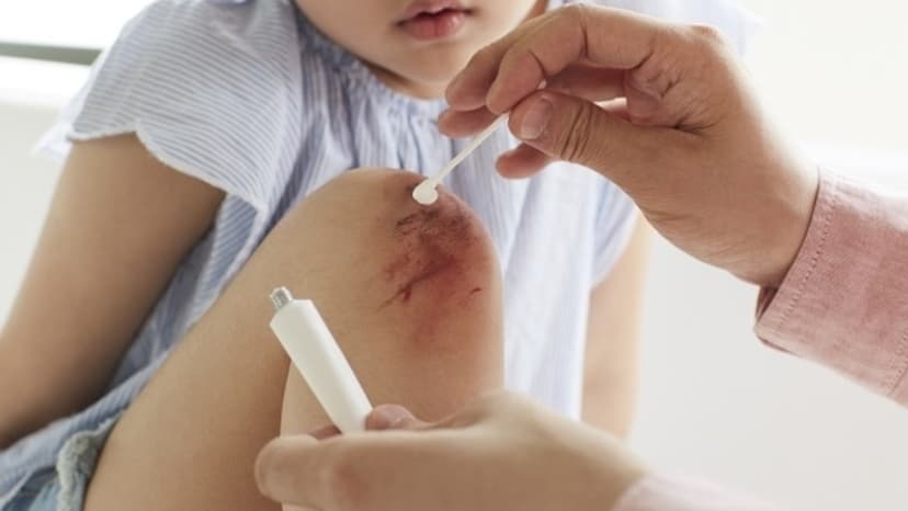 Rắc/ bôi thuốc kháng sinh vào vết thương hở có sao không?