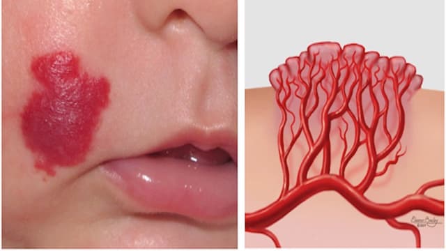 Cách nhận biết u máu ở trẻ sơ sinh