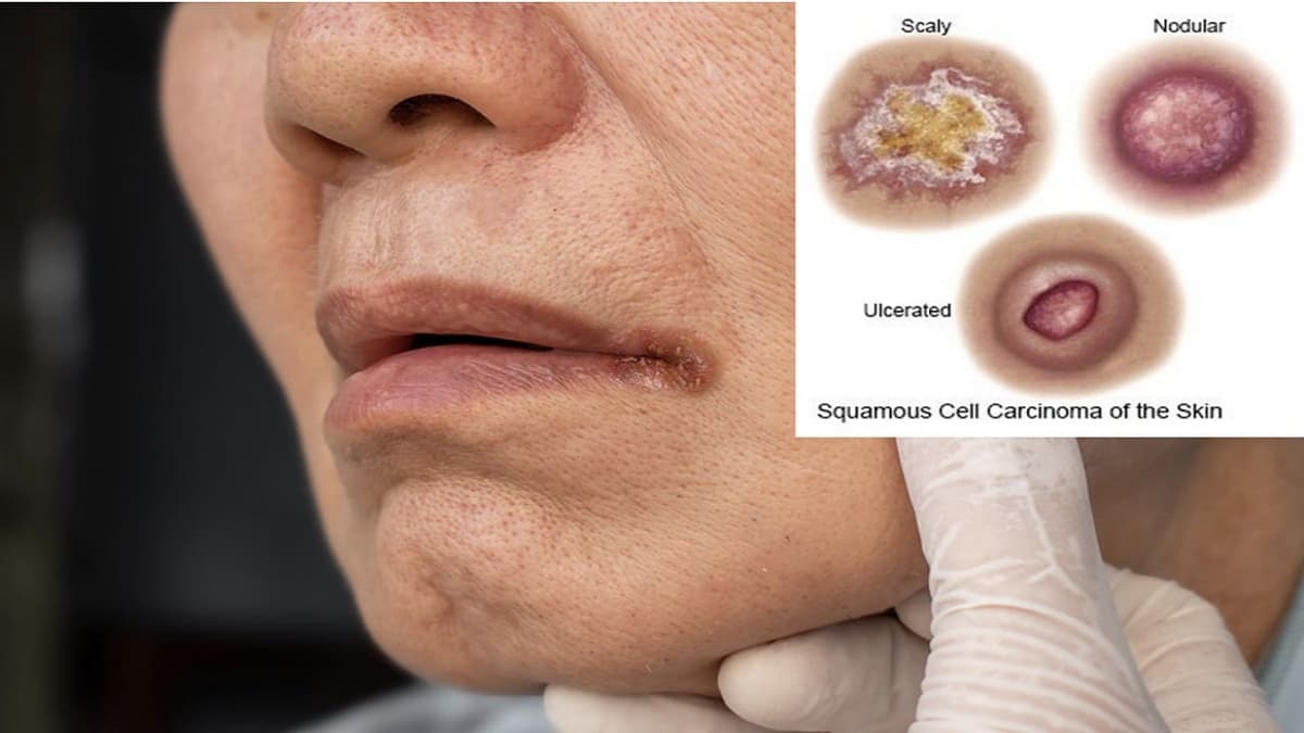 Carcinoma là ung thư gì?