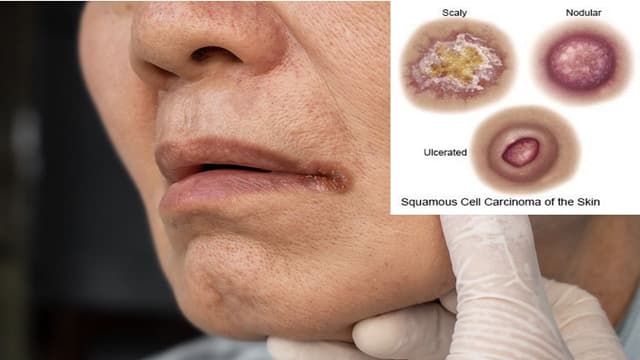 Carcinoma là ung thư gì?